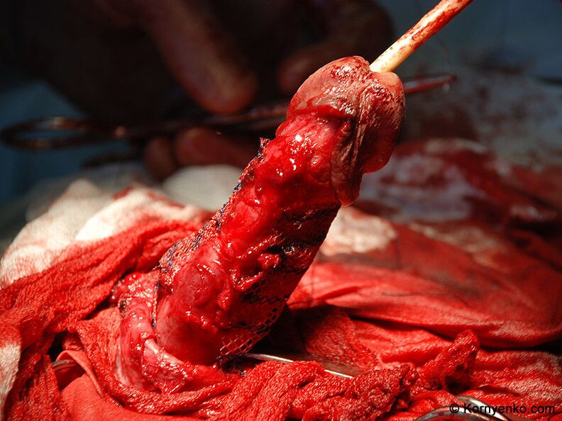 Install collagen matrix to increase penis size