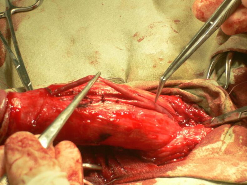 lipofilling the penis for enlargement