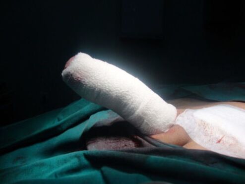 Bandaged penis after enlargement surgery