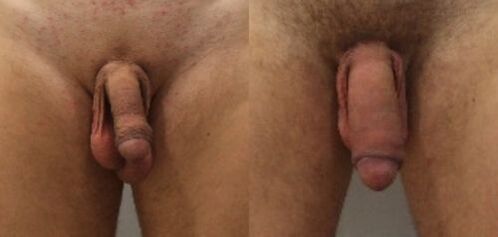 Before and after penis enlargement surgery