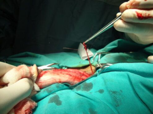 Penis enlargement surgery