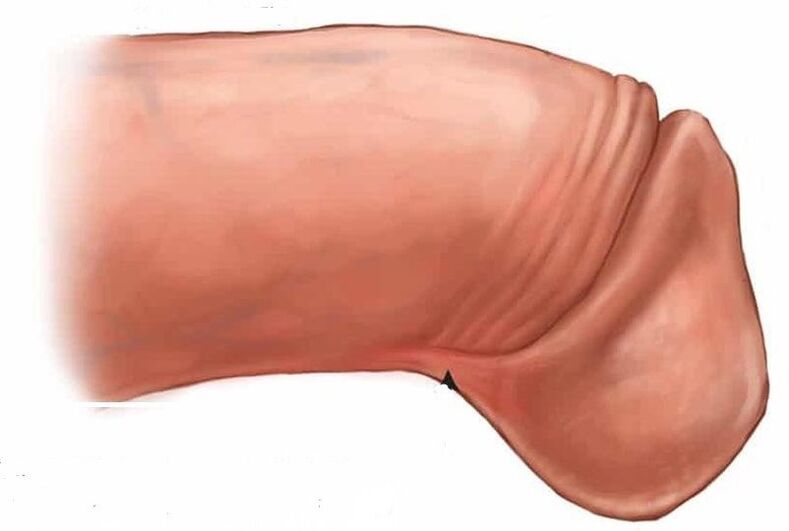 How to enlarge the glans of the penis