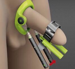 Rehabilitation after penis enlargement surgery